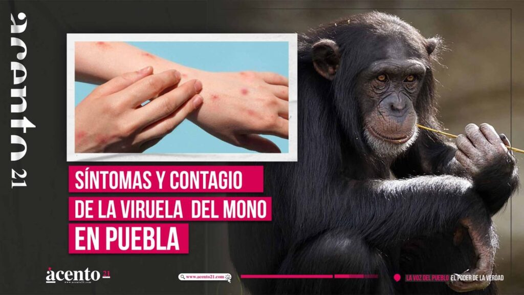 Síntomas y contagio de la viruela del mono en Puebla