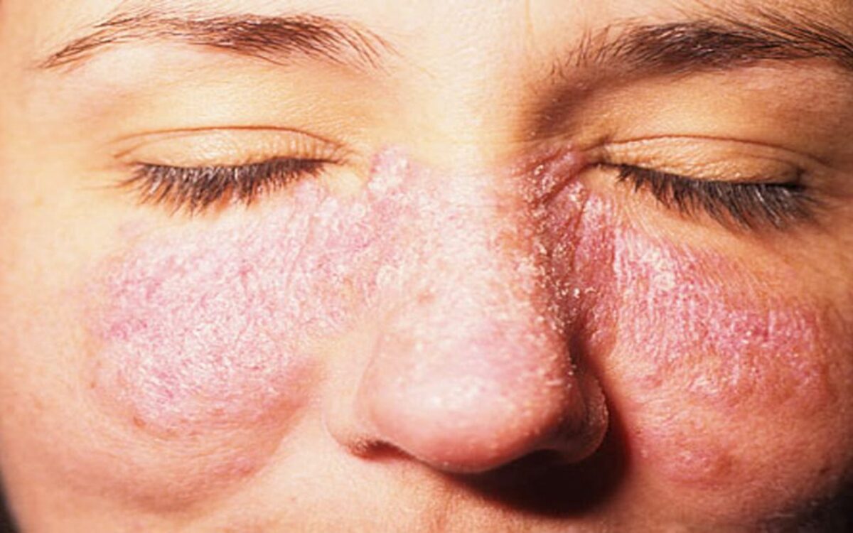 Día Mundial del Lupus: visibilizando una enfermedad silenciosa