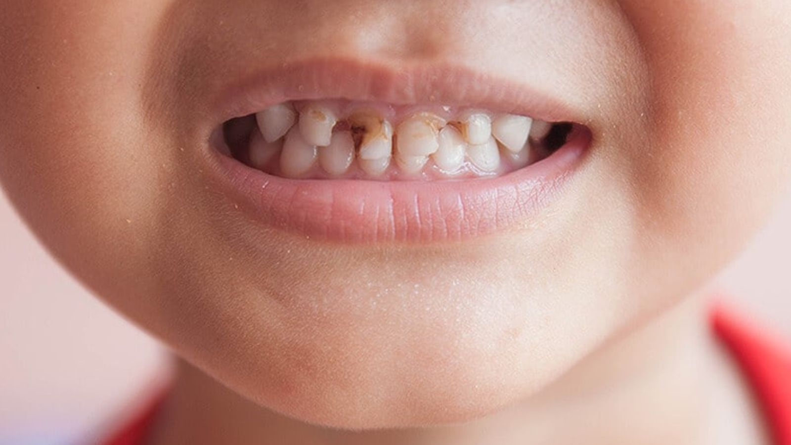 Puebla de las caries: estado se coloca como segundo lugar con más casos Puebla de las caries: estado se coloca como segundo lugar con más casos