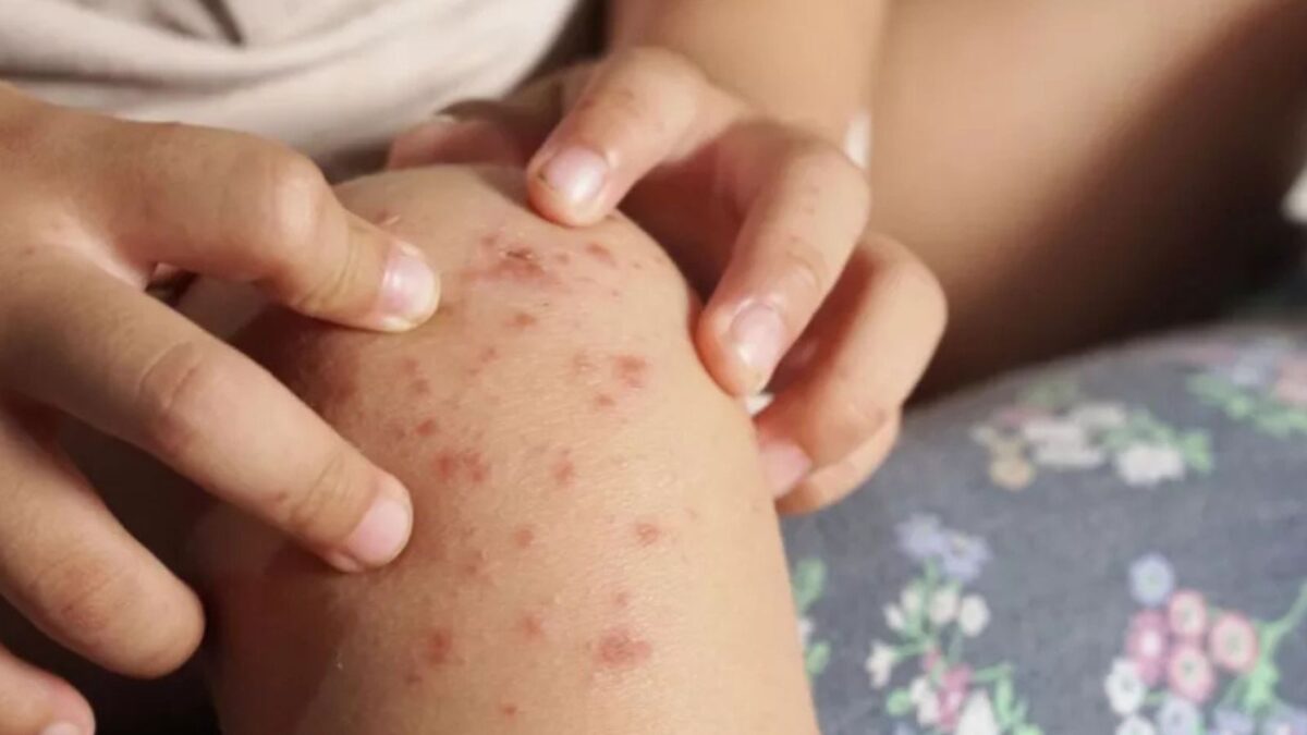 En 2025 se registran 29 brotes del virus Coxsackie en Puebla